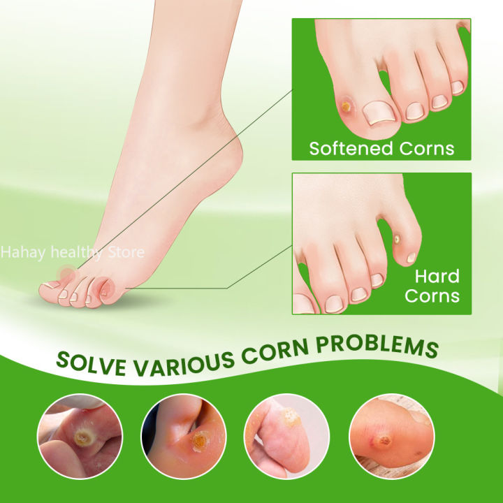 Foot%20Corn%20Remover%20Cream%20Chicken%20Eye%20Skin%20Infection%20Treatment%20Ointment%20Feet%20Dead%20Skin%20Calluses%20Removal%20Tool%20Health%20Care%20%EB%82%B4%EC%84%B1%EB%B0%9C%ED%86%B1%20-%20Image%204