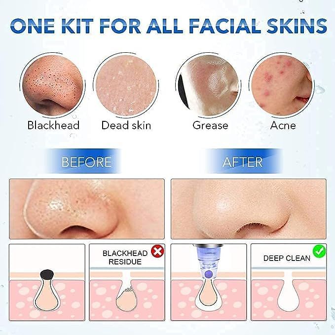 4%20in%201%20Multi-function%20Blackhead%20Remover%20Vacuum%20Pimple%20Tool%20For%20Men%20And%20Women%20Blackheads%20Remover%20Tool%20Kit,%20Acne%20Remover,%20Pore%20Cleaner,%20Facial%20Beauty%20Care%20-%20Image%207