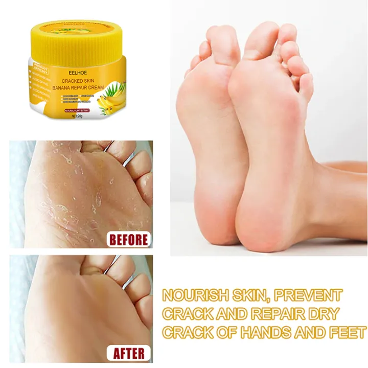 Foot%20crack%20repair%20and%20dryness%20healing%20cream%2020g%20big%20pack%20Natural%20ingredients%20-%20Image%207