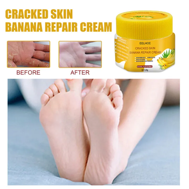 Foot%20crack%20repair%20and%20dryness%20healing%20cream%2020g%20big%20pack%20Natural%20ingredients%20-%20Image%206