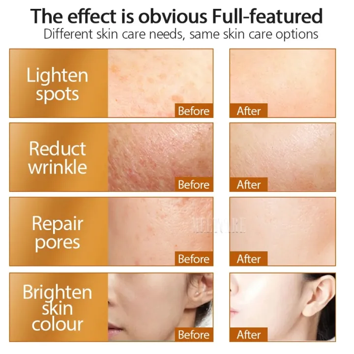 Professional%20Derma%20Roller%20Growth%20&%20Hair%20Regrowth%20Micro%20Needles%20Derma%20Roller%20Anti-Aging%20Skin%20Care%20Beauty%20Tool,Gold%20%20Derma%20Roller%20REAL%20NEEDLES%20%20Microneedles%20Dermaroller%20Micro%20Needle%20Roller%20Microneedling%20Derma%20Needling%20Kit%20-%20Image%206