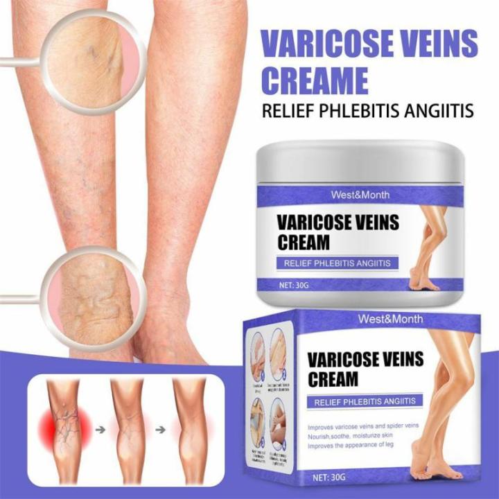 Varicose Vein Treatments Cream Effective Relieve Legs Dilated Vasculitis Phlebitis Natural Formula Ointment For Varicose Veins