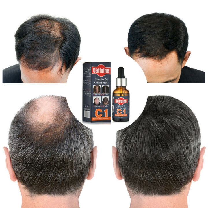 Caffeine%20Hair%20Essential%20Oil%20Anti%20Hair%20loss/%20Control%20Hair%20Loss-30ml%20(cheo)%20-%20Image%209