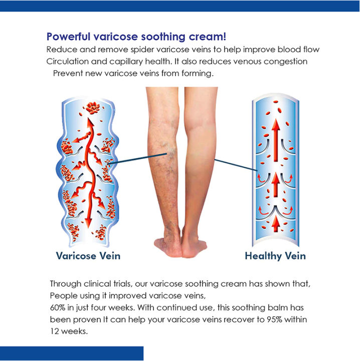 20g%20Varicose%20Vein%20Relief%20Cream%20Tongmai%20Effective%20Relieves%20Leg%20Bulge%20Pain%20Plant%20Extracts%20Treatment%20and%20Repair%20Cream%20Skin%20Care%20-%20Image%206