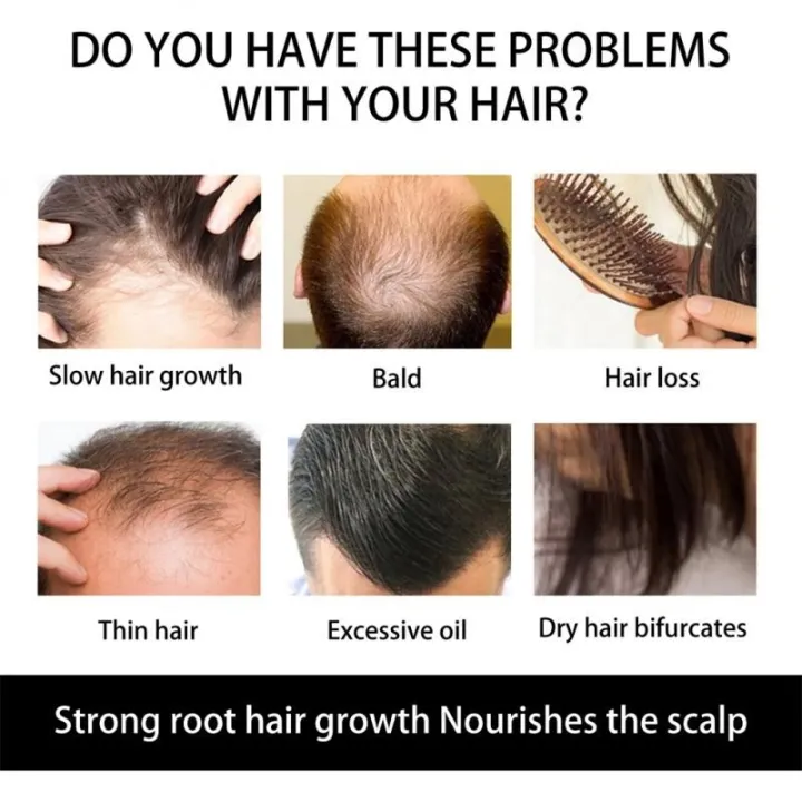 New%20Dermaroller%20For%20Men%20Micro%20Hair%20Derma%20Roller%20Regrowth%20Beard%20Growth%20Anti%20Loss%20Roll%20Tool%20%E3%80%90hot%E3%80%91%E2%99%82%E2%9C%B4%E2%9C%93%20-%20Image%206