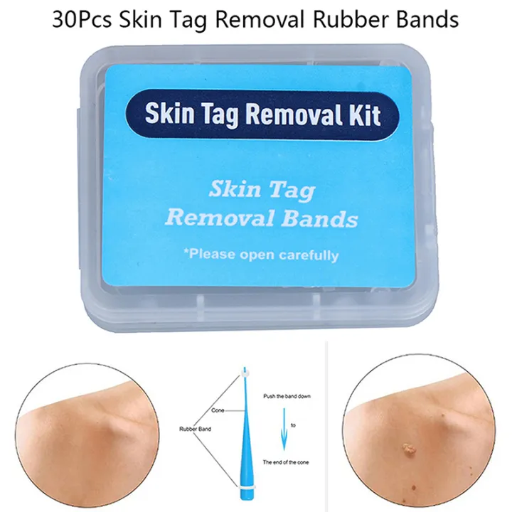 20pcs%20Skin%20Tag%20Removal%20Rubber%20Bands%20Micro%20Band%20Non%20Toxic%20Face%20Care%20Mole%20Wart%20Skin%20Care%20Tools%20-%20Image%202