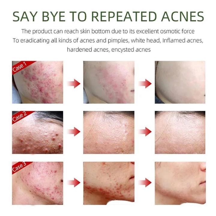 Azelaic%20Acid%20Acne%20Cream%20Remove%20Acnes%20Pimples%20Whiten%20Dark%20Spot%20Scars%20Anti%20Acne%20Treatment%20Gel%20Shrink%20Pores%20Oil%20Control%20Face%20Care%20-%20Image%205