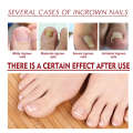 Jaysuing Soft Brightening Repair Ingrown Toenail Thickening Type Gray Nail Care Essence Oil. 