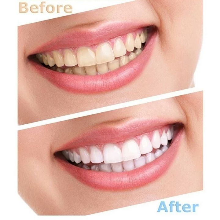 %E3%80%90New%20design%E3%80%91Teeth%2044%25%20Peroxide%20Bleaching%20System%20Oral%20Gel%20Kit%20Whitener%20Equipment%20Professional%2010/6/5/3pcs%20-%20Image%204
