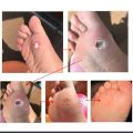 warts removal Corn Plaster for 14 days easy wart removal without any pain - 7 pack. 