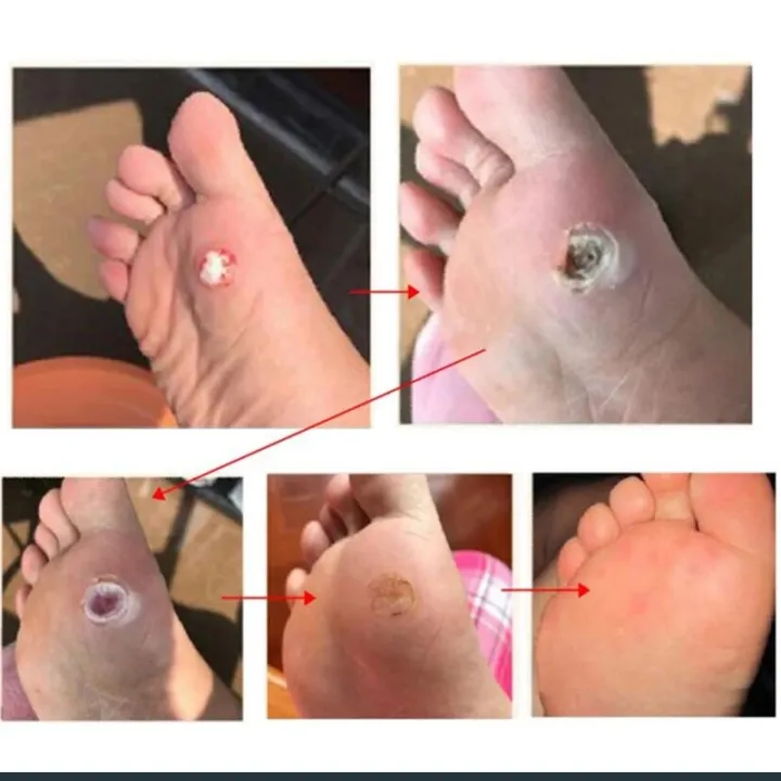 warts%20removal%20Corn%20Plaster%20for%2014%20days%20easy%20wart%20removal%20without%20any%20pain%20-%207%20pack%20-%20Image%203