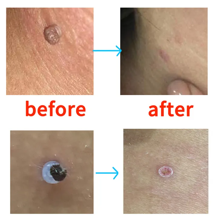 20pcs%20Skin%20Tag%20Removal%20Rubber%20Bands%20Micro%20Band%20Non%20Toxic%20Face%20Care%20Mole%20Wart%20Skin%20Care%20Tools%20-%20Image%208