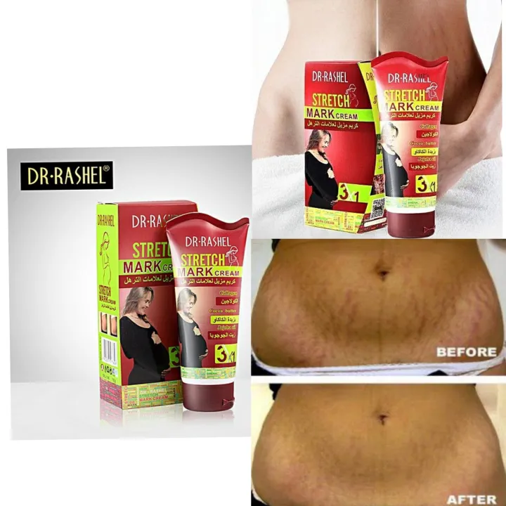 Dr.Rashel%203%20in%201%20Stretch%20Mark%20Remover%20Cream%20150g%20-%20Image%204