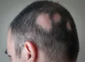 Ayurvedic Udugowwa Balm & Oil Pack – Effective Herbal Remedy for Hair Loss. 