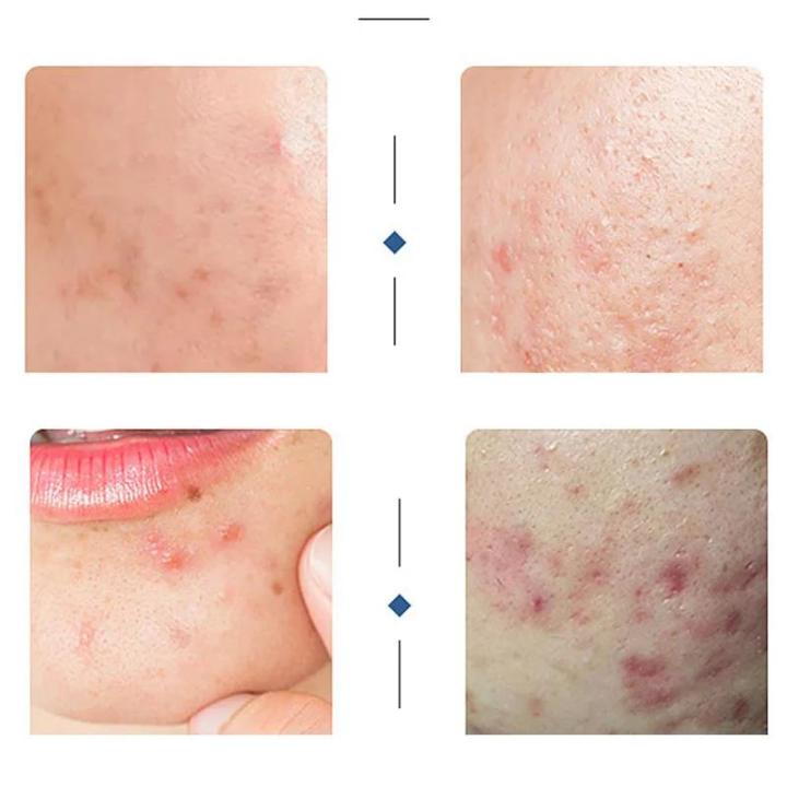 Azelaic%20Acid%20Acne%20Cream%20Remove%20Acnes%20Pimples%20Whiten%20Dark%20Spot%20Scars%20Anti%20Acne%20Treatment%20Gel%20Shrink%20Pores%20Oil%20Control%20Face%20Care%20-%20Image%203