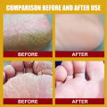 Foot crack repair and dryness healing cream 20g big pack Natural ingredients. 