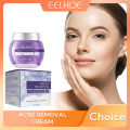 Fade Pimple Mark Cream Anti Acne Blemish Oil Control Shrink Pore Remove Dark Spot Inflammatory Treatment Moisturize Whiten Gel. 