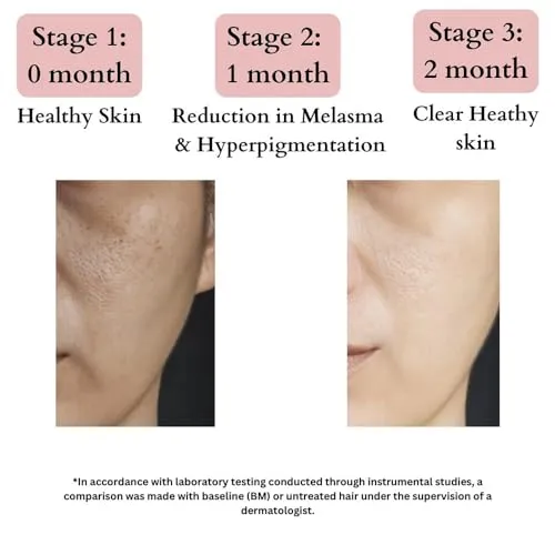 BLUSHLIN%2010%25%20Tranexamic%20Acid%20Cream%20with%202%25%20Kojic%20Acid%20+%205%25%20Vitamin%20C%20+%201%25%20Arbutin%20%7C%20Pigmentation%20Removal%20Face%20Cream%20%7C%20Helps%20Even%20Skin%20Tone,%20Reduce%20Dark%20Spots,%20Blemishes%20and%20Scars%20-%2010gm(FROM%20INDIA)JEZ%20-%20Image%202