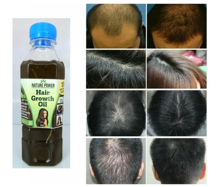 Ayurvedic%20100%25%20Natural%20Hair%20Growth%20Oil%20for%20Men,%20Women,%20&%20Children%20-%20200ml"%20-%20Image%202