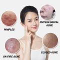 Azelaic Acid Clear Gel 20% 30g, Hormone Acne Pimple Blemish Repair Refine Pores Moisturize Skin. 