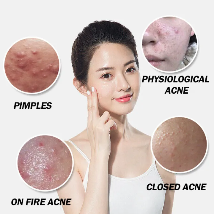 Azelaic%20Acid%20Clear%20Gel%2020%25%2030g,%20Hormone%20Acne%20Pimple%20Blemish%20Repair%20Refine%20Pores%20Moisturize%20Skin%20-%20Image%203