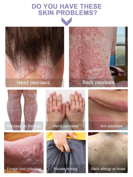 Psoriasis%20Dermatitis%20Eczematoid%20Eczema%20Cream%2025g%20%7C%20Natural%20Plant%20Extract%20%7C%20Anti%20Itch%20Chinese%20Herb%20Medical%20Skin%20Care%20Ointment%20-%20Image%206