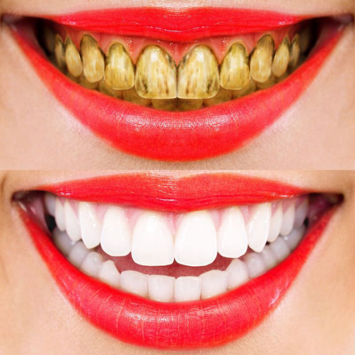 30PCS%20Professional%20Oral%20Care%20Hygiene%20Teeth%20%20Whiten%20Tools%20Teeth%20Whitening%20Strips%20Gel%20Dental%20Bleaching%20Tooth%20Whitening%20Strip%20Use%20For%20All%20People%20At%20Home%20Make%20Your%20Teeth%20Beautiful%20All%20People%20Could%20Use%20Close%20to%20the%20teeth%20-%20Image%204