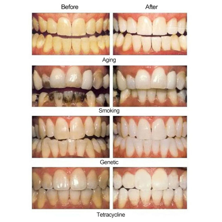 30PCS%20Professional%20Oral%20Care%20Hygiene%20Teeth%20%20Whiten%20Tools%20Teeth%20Whitening%20Strips%20Gel%20Dental%20Bleaching%20Tooth%20Whitening%20Strip%20Use%20For%20All%20People%20At%20Home%20Make%20Your%20Teeth%20Beautiful%20All%20People%20Could%20Use%20Close%20to%20the%20teeth%20-%20Image%205