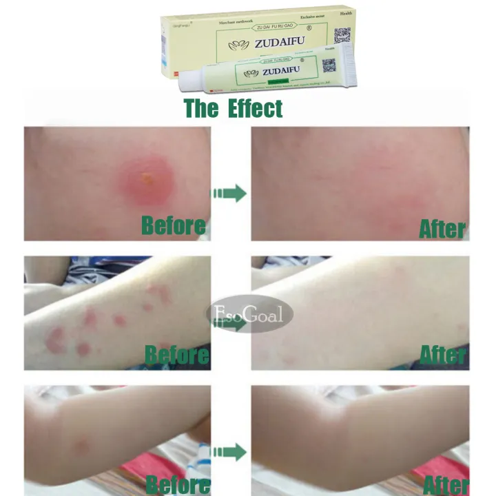 EsoGoal%20Natural%20Chinese%20Herbal%20%20Cream%20Eczema%20Dermatitis%20Psoriasis%20Vitiligo%20Antibacterial%20Skin%20Disease%20Treatment%20ZUDAIFU,%201%20Tube/Box(15g)%20-%20Image%208