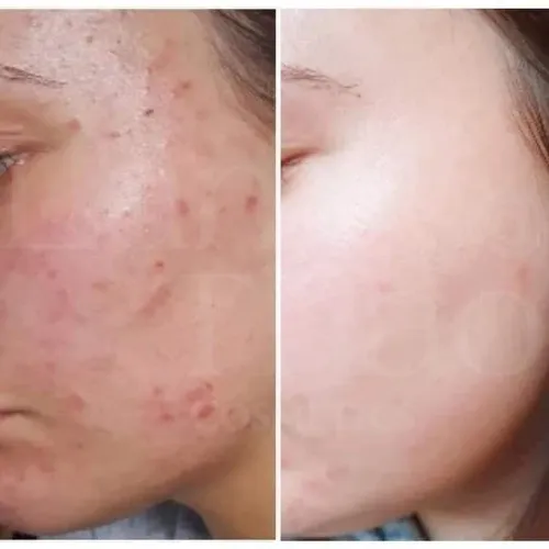 Care:nel%20Dr%20skin%20niacinamide%20zinc%20serum%20(30%20ml)%20-%20Image%2010