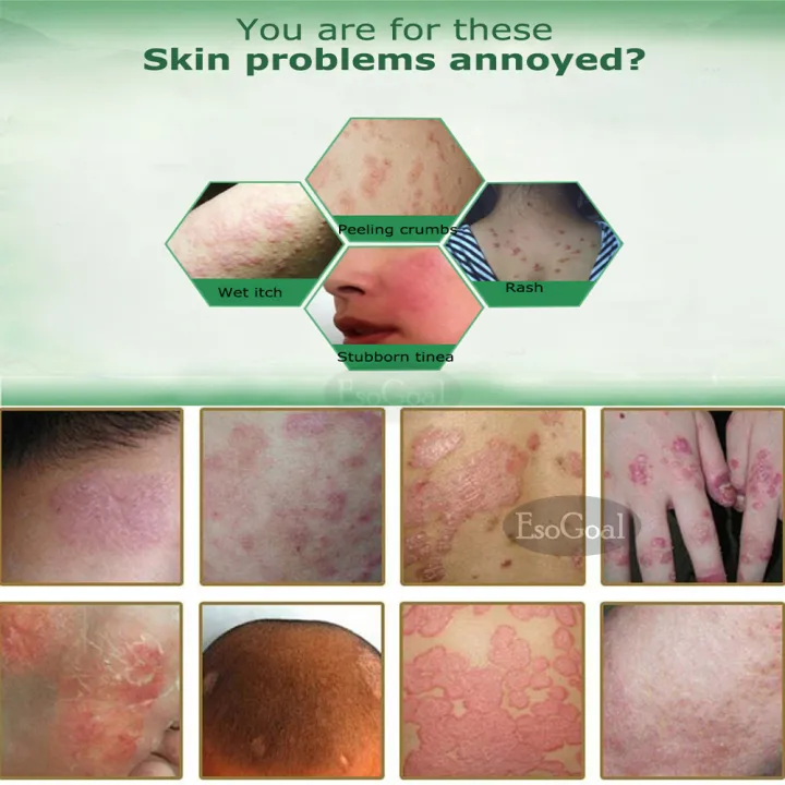 EsoGoal%20Natural%20Chinese%20Herbal%20%20Cream%20Eczema%20Dermatitis%20Psoriasis%20Vitiligo%20Antibacterial%20Skin%20Disease%20Treatment%20ZUDAIFU,%201%20Tube/Box(15g)%20-%20Image%207