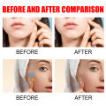 (Preorder)Sevich 200patches Star Shaped Acne Removal Pimple Patches Facial Care Stickers Skin Tag Remover Patch Star Acne Patch Acne Spot Treatment Ance Pimple Patches. 