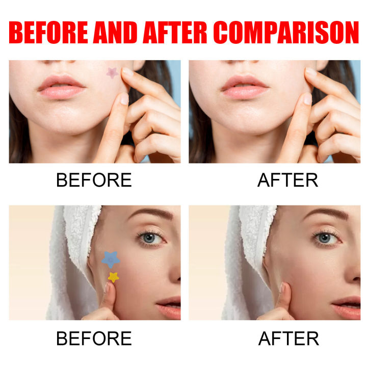 (Preorder)Sevich%20200patches%20Star%20Shaped%20Acne%20Removal%20Pimple%20Patches%20Facial%20Care%20Stickers%20Skin%20Tag%20Remover%20Patch%20Star%20Acne%20Patch%20Acne%20Spot%20Treatment%20Ance%20Pimple%20Patches%20-%20Image%205