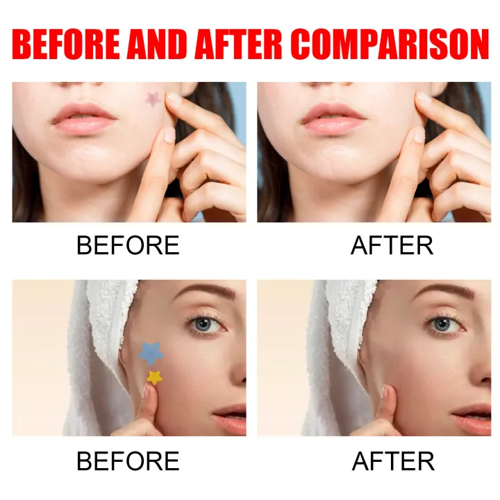 (Preorder)Sevich%20200patches%20Star%20Shaped%20Acne%20Removal%20Pimple%20Patches%20Facial%20Care%20Stickers%20Skin%20Tag%20Remover%20Patch%20Star%20Acne%20Patch%20Acne%20Spot%20Treatment%20Ance%20Pimple%20Patches%20-%20Image%205