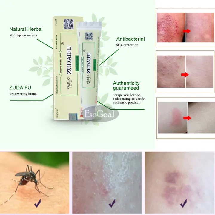 EsoGoal%20Natural%20Chinese%20Herbal%20%20Cream%20Eczema%20Dermatitis%20Psoriasis%20Vitiligo%20Antibacterial%20Skin%20Disease%20Treatment%20ZUDAIFU,%201%20Tube/Box(15g)%20-%20Image%204