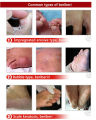 Relieve Itch Tinea Pedis Ointment 15g, Beriberi Cream, Athlete's Foot Toe Fungus Ringworm Itching Infection Paronychia Treatment. 
