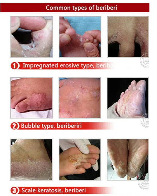 Relieve%20Itch%20Tinea%20Pedis%20Ointment%2015g,%20Beriberi%20Cream,%20Athlete's%20Foot%20Toe%20Fungus%20Ringworm%20Itching%20Infection%20Paronychia%20Treatment%20-%20Image%203