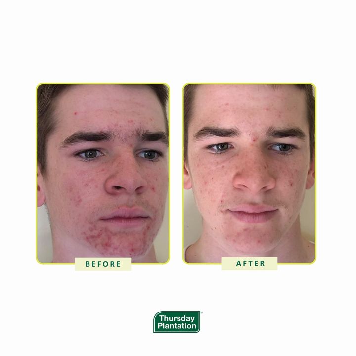 Thursday%20Plantation%20Tea%20Tree%20Medicated%20Gel%20For%20Acne%20-%20Image%205