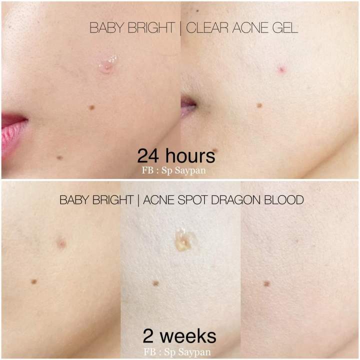BABY%20BRIGHT_CLEAR%20ACNE%20GEL%2015G%20-%20Image%204