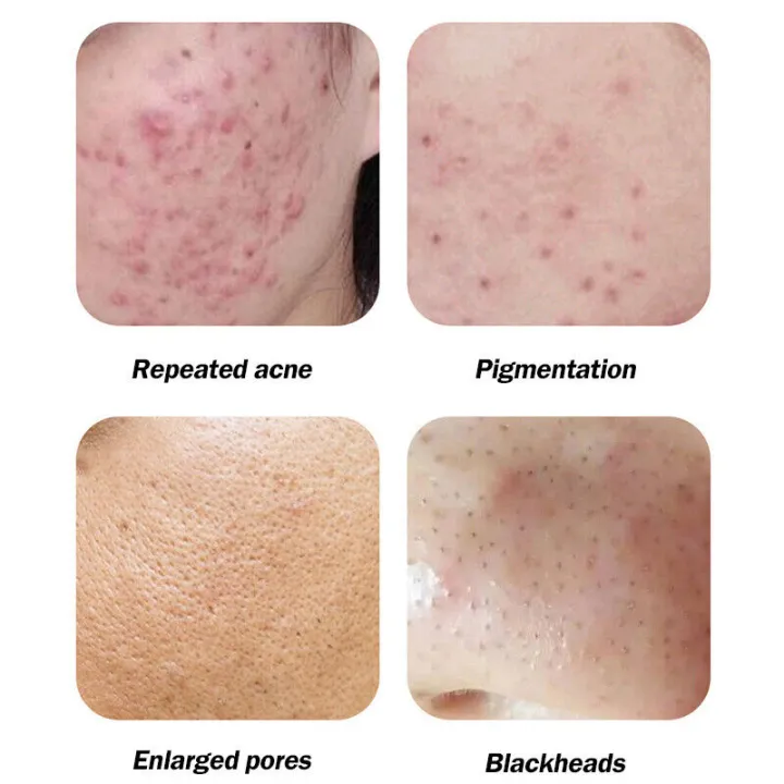 Azelaic%20Acid%20Clear%20Gel%2020%25%2030g,%20Hormone%20Acne%20Pimple%20Blemish%20Repair%20Refine%20Pores%20Moisturize%20Skin%20-%20Image%204