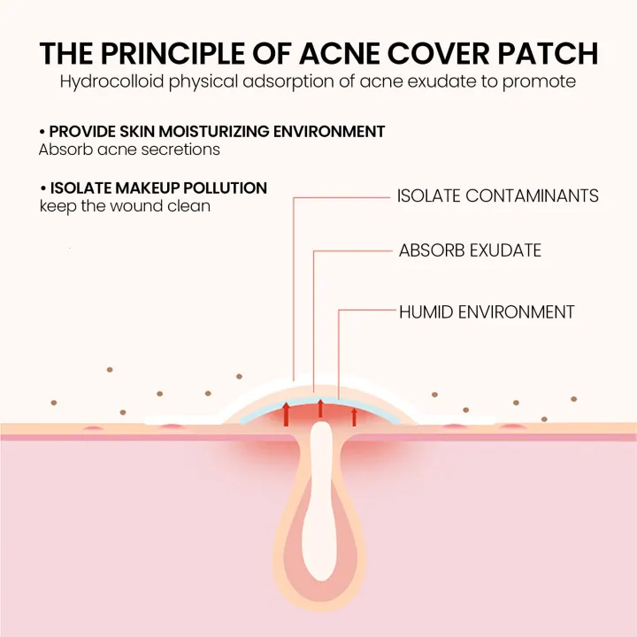 (Preorder)Sevich%20200patches%20Star%20Shaped%20Acne%20Removal%20Pimple%20Patches%20Facial%20Care%20Stickers%20Skin%20Tag%20Remover%20Patch%20Star%20Acne%20Patch%20Acne%20Spot%20Treatment%20Ance%20Pimple%20Patches%20-%20Image%207