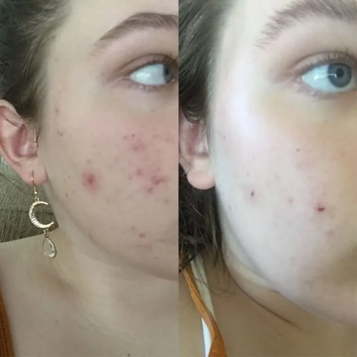Thursday%20Plantation%20Tea%20Tree%20Medicated%20Gel%20For%20Acne%20-%20Image%204