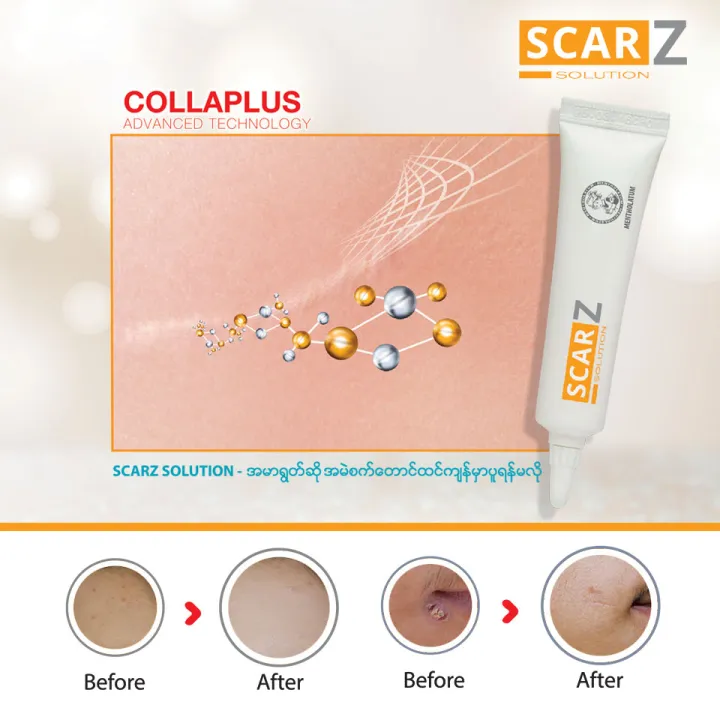 SCAR%20Z%20SCAR%20TREATMENT%2012G%20-%20Image%204