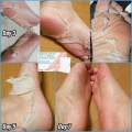Foot peeling mask. 
