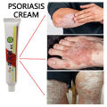 Psoriasis Dermatitis Eczematoid Eczema Cream 25g | Natural Plant Extract | Anti Itch Chinese Herb Medical Skin Care Ointment. 