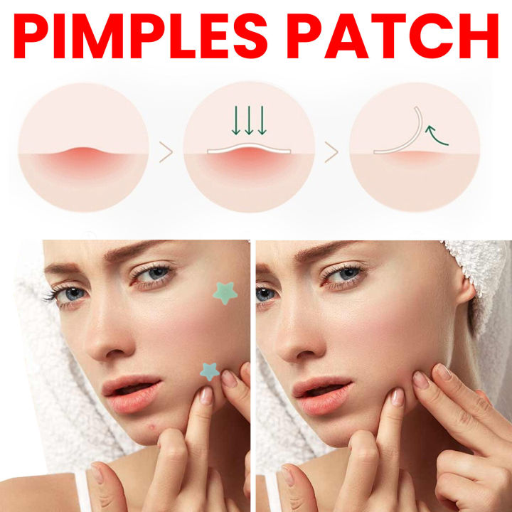 (Preorder)Sevich%20200patches%20Star%20Shaped%20Acne%20Removal%20Pimple%20Patches%20Facial%20Care%20Stickers%20Skin%20Tag%20Remover%20Patch%20Star%20Acne%20Patch%20Acne%20Spot%20Treatment%20Ance%20Pimple%20Patches%20-%20Image%204