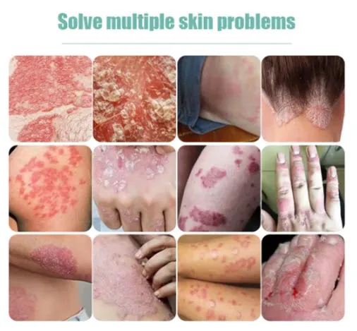 Psoriasis%20Dermatitis%20Eczematoid%20Eczema%20Cream%2025g%20%7C%20Natural%20Plant%20Extract%20%7C%20Anti%20Itch%20Chinese%20Herb%20Medical%20Skin%20Care%20Ointment%20-%20Image%207