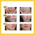 Scar Removal Cream - TCM Scar Cream for Surgical Scars, Acne Skin Care Cream, Acne Treatment Cream for Scars, Burns, Stretch Marks, Acne Spots. 