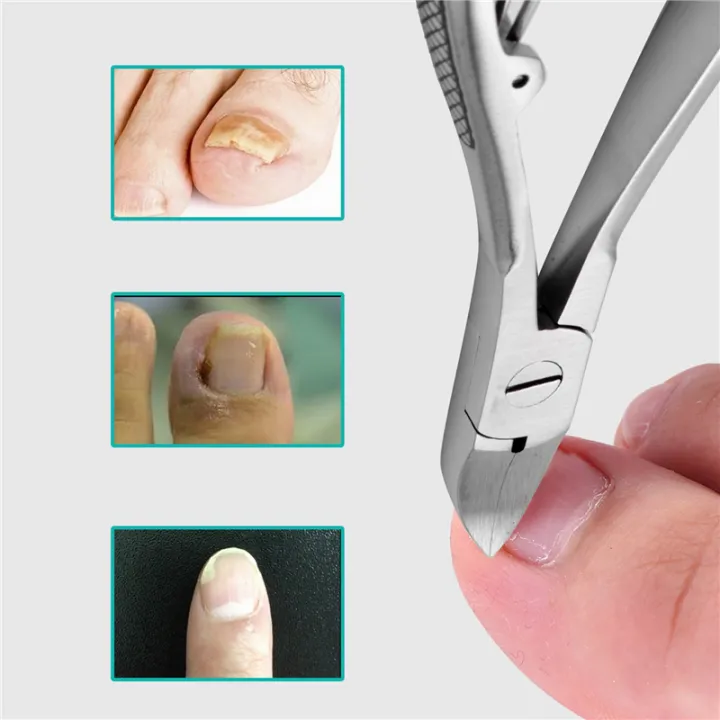 FORIDE%202X%20Professional%20Feet%20Toe%20Nail%20Clippers%20Trimmer%20Cutters%20Paronychia%20Nippers%20Podiatry%20Stainless%20Foot%20Care%20Tools%20-%20Image%203