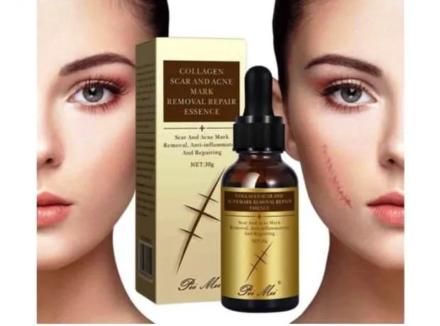 Scar%20Removal%20Cream%20-%20TCM%20Scar%20Cream%20for%20Surgical%20Scars,%20Acne%20Skin%20Care%20Cream,%20Acne%20Treatment%20Cream%20for%20Scars,%20Burns,%20Stretch%20Marks,%20Acne%20Spots%20-%20Image%208